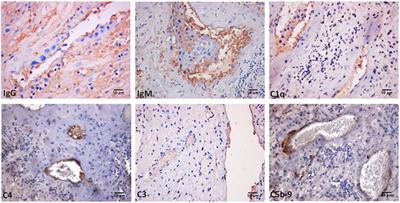 Pathogenic Role of Complement in Antiphospholipid Syndrome and Therapeutic Implications